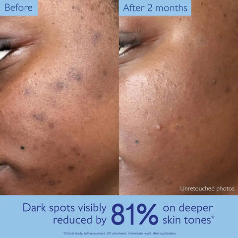 Brightening Dark Spot Serum Vitamin C Alternative