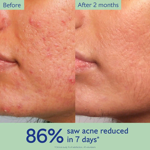 Acne-Prone Skin Essentials
